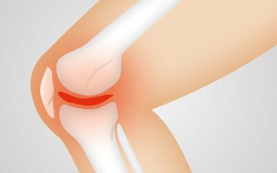 Safe Training After Knee Replacements